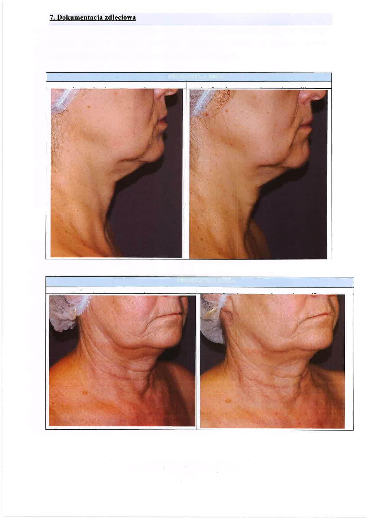 Original before and after photographs KA/64